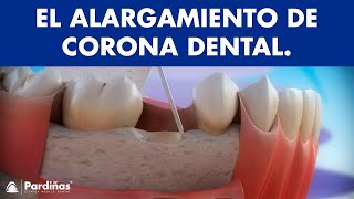 Alargamiento de corona dental © [upl. by Deutsch]