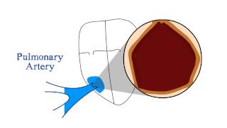 Pulmonary Stenosis [upl. by Oakes]