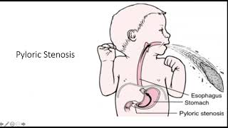 Hypertrophic Pyloric Stenosis [upl. by Katz]