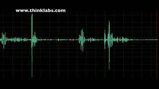 Pulmonary Stenosis mild [upl. by Enniotna]