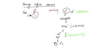 pyloric stenosis Electrolyte disturbances [upl. by Sellers]