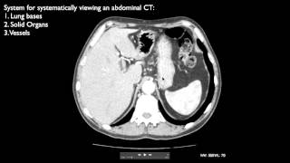 How to interpret an abdominal CT [upl. by Marmaduke202]