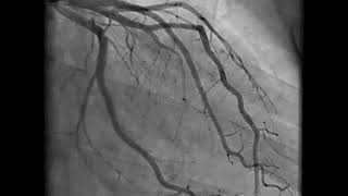 Coronary Angiography  NEJM [upl. by Kiel]