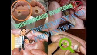 Trichomoniasis symptomsTreatment and Prevention [upl. by Safoelc498]