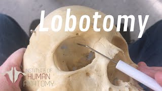 The Anatomy of a Lobotomy [upl. by Henrik]