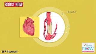 EECP Treatment In Chandigarh  Heart Blockage Treatment  Dr Sanjeev Vats EECP Expert  HealthFinder [upl. by Aicemed]