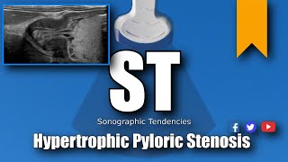 Pyloric Ultrasound [upl. by Gillespie]