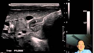 Pyloric Stenosis ULTRASOUND DISCUSSION 2 [upl. by Buderus662]