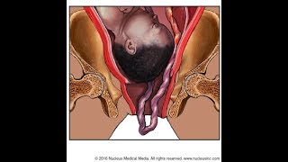 Umbilical Cord Prolapse [upl. by Eecram]