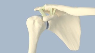 Dislocating Knee Cap Surgery  MPFL Reconstruction [upl. by Ebert802]