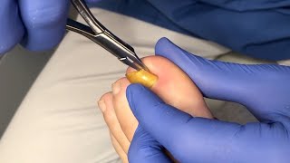 Usuwanie wrastającego fragmentu paznokcia  Ingrown toenail removal [upl. by Enelyam]