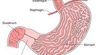 Pyloric Stenosis [upl. by Eirollam]