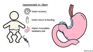 Hypertrophic Pyloric Stenosis [upl. by Larissa571]